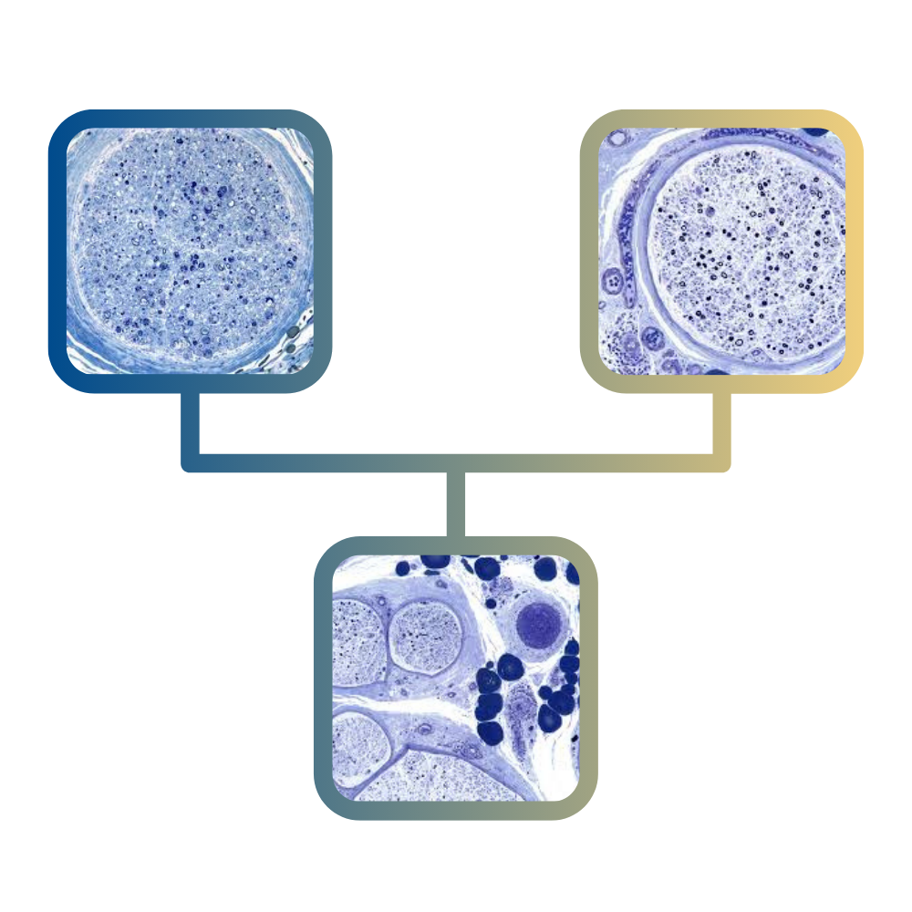 Microscopic images of nerve cells illustrating different types of peripheral neuropathy, including mononeuropathy and polyneuropathy, relevant to pain management and neuropathy treatment at Cleveland Pain Relief Center.