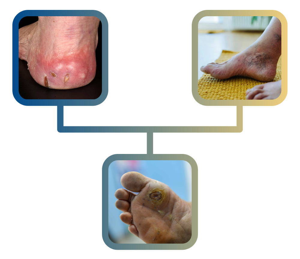 Diabetic foot ulcerations depicting three feet with visible sores and discoloration, highlighting complications of diabetic peripheral neuropathy.